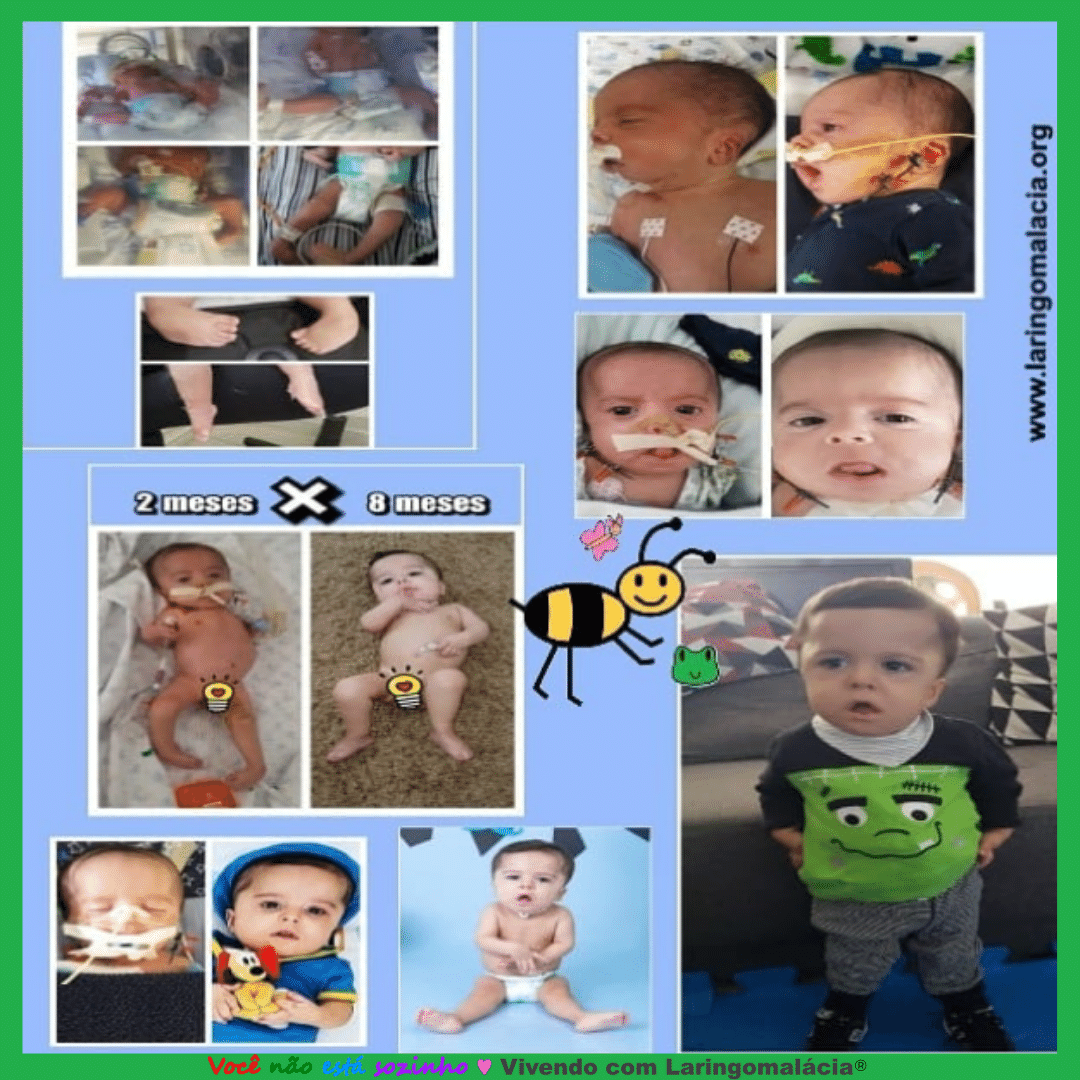 Vivendo com Laringomalácia